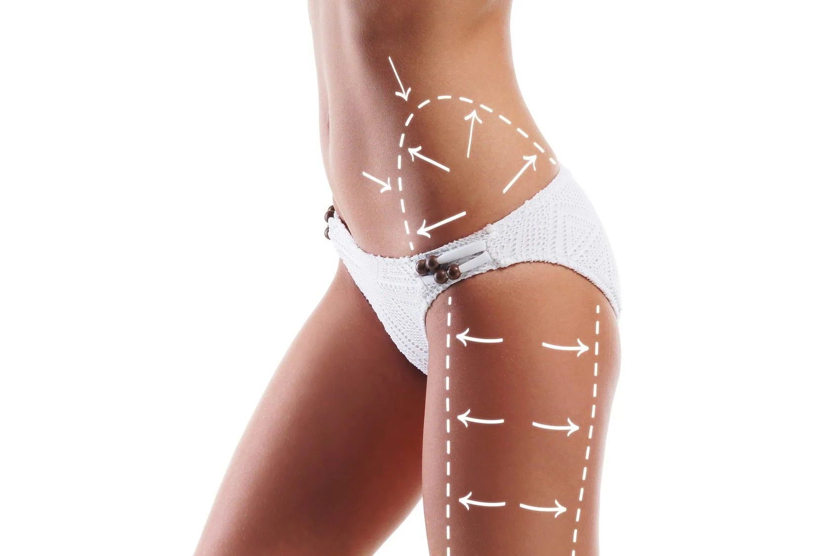 Das Bild zeigt den Körper einer jungen Frau mit eingezeichneten Pfeilen – Symbol für Fettabbau, Cellulite-Reduktion und Körperformung.