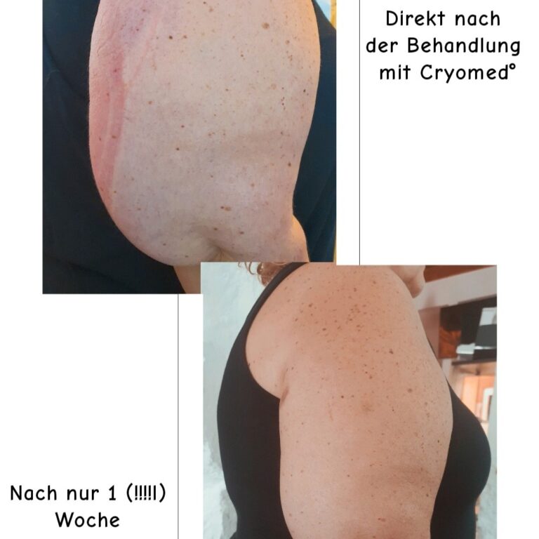 Das Bild zeigt eine Vergleichscollage mit Vorher-Nachher-Fotos der CryoMed®-Anwendung.